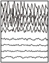 Partielle anfall EEG