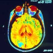 En MR av hjernen kan vise om kreften har spredt seg (metastasert) der.