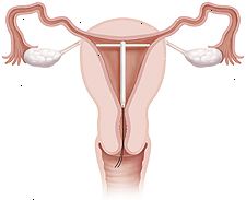 Tverrsnitt av livmor og vagina viser spiralen på plass inni livmoren.