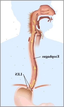 Omrisset av en menneskelig figur som viser anatomien i øvre fordøyelsessystemet fra munn til mage. Spiserøret går gjennom membranen til å koble seg til magen. Svake LES er åpen og pilene viser bevegelse av mageinnhold opp i spiserøret og bak i halsen. Baksiden av halsen er betent.