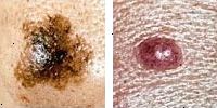 Foto sammenligne normale og melanom føflekker som viser asymmetri