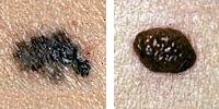 Bilde sammenligne normale og melanom føflekker som viser grensen uregelmessighet