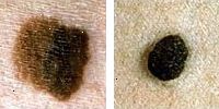 Bilde sammenligne normal og melanom føflekker som viser farge