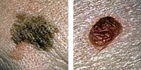 Foto sammenligne normale og melanom føflekker som viser diameter