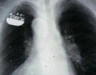 X-ray av en enkelt-kammer implantert pacemaker