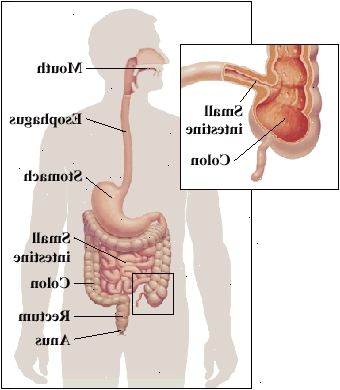 Enhver del av fordøyelseskanalen, fra munnen til anus, kan bli påvirket. Det er ofte funnet hvor tynntarmen og tykktarmen møtes.
