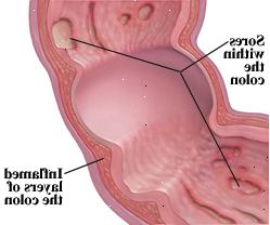 Crohns sykdom kan påvirke alle lagene i fordøyelseskanalen.