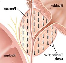 Nærbilde tverrsnitt av blære, prostata og rektum. Radioaktive frø er implantert i hele prostata.