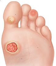 Fotsåle viser sår på ballen av foten, callus på undersiden av stortåen, og hot spot på pute av tredje tå.