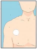 Fest plasteret et tørt sted på brystet, øvre del av ryggen, eller overarmen.