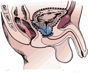 Kirurgiske grensene for radikal cystektomi i en mann. Prøven omfatter blæren, prostata og seminal-vesikler.