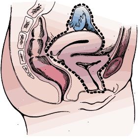 Kirurgiske grensene for radikal cystektomi i en kvinne. Prøven omfatter blæren og hele urinrør, uterus, ovarier, eggledere, og den fremre veggen av vagina.