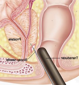 Closeup tverrsnitt av prostata og endetarm. Transducer settes inn i rectum og nålen settes inn i prostata.