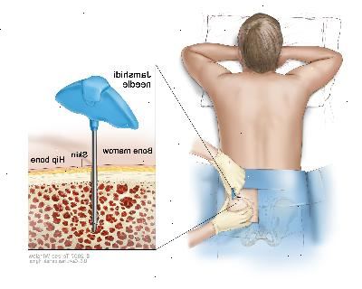 Benmargs aspirasjon og biopsi, tegning viser en pasient liggende med ansiktet ned på et bord og en Jamshidi nål (en lang, hul nål) blir satt inn i hoftebenet. Inset viser Jamshidi nålen er satt inn gjennom huden og inn i beinmargen av hoftebenet.