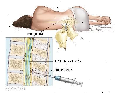 Spinalpunksjon. En pasient som ligger i en krøllet posisjon på et bord. Etter et lite område i nedre del av ryggen er nummen, en spinalnål (en lang, tynn nål) settes inn i den nedre del av ryggraden for å fjerne cerebrospinalvæske (CSF, som er vist i blått). Væsken kan sendes til et laboratorium for testing.