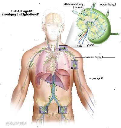 Stage II voksen non-Hodgkin lymfom; tegningen viser kreft i lymfeknute grupper over og under mellomgulvet. En innfelt viser en lymfeknute med en lymfe fartøy, en arterie og en vene. Lymfom celler inneholdende cancer er vist i lymfeknute.