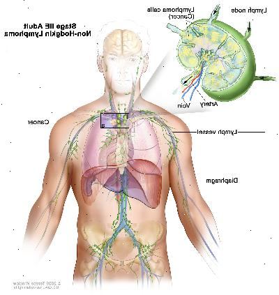 Stage IIE voksen non-Hodgkin lymfom; tegningen viser kreft i en lymfeknute gruppe ovenfor mellomgulvet og i venstre lunge. En innfelt viser en lymfeknute med en lymfe fartøy, en arterie og en vene. Lymfom celler inneholdende cancer er vist i lymfeknute.