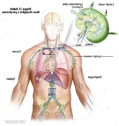 Stage III voksen non-Hodgkin lymfom. Kreft er funnet i en eller flere lymfeknute grupper over og under membranen (a). I scenen IIIE, er kreft funnet i lymfeknute grupper over og under mellomgulvet og utenfor lymfeknutene i et nærliggende organ eller område (b). I stadium IIIS er kreft i lymfeknutegrupper over og under membranen (a), og i milten (c). I trinn IIIS pluss E, er kreft i lymfeknutegrupper over og under mellomgulvet, utenfor lymfeknutene i et nærliggende organ eller område (b), og i milten (c).