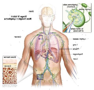 Stadium IV voksen non-Hodgkin lymfom; tegningen viser kreft i leveren, venstre lunge, og i en lymfeknute-gruppen under mellomgulvet. Hjernen og pleura er også vist. En innfelt viser et nærbilde av kreft sprer seg gjennom lymfeknuter og lymfeårer til andre deler av kroppen. Lymfom celler som inneholder kreft er vist inne i en lymfeknute. En annen innsatt viser kreftceller i benmargen.