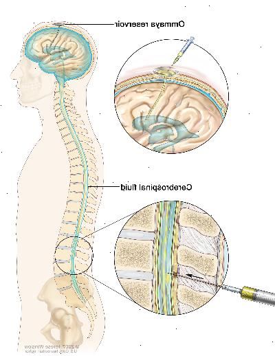 Intratekal kjemoterapi. Anticancer legemidler som injiseres i intratekalrommet, som er det rom som inneholder cerebrospinalvæsken (CSF, som er vist i blått). Det er to forskjellige måter å gjøre dette. En måte som er vist på den øverste delen av figuren, er å injisere medikamentene inn i en Ommaya reservoar (en kuppel-formet beholder som er plassert under hodebunnen under en operasjon, det har medikamentene som de strømmer gjennom et lite rør inn i hjernen ). Den andre måten som er vist på den nederste del av figuren, er å injisere de legemidler direkte inn i CSF i den nedre del av ryggsøylen, etter et lite område i den nedre del av ryggen er sløvet.