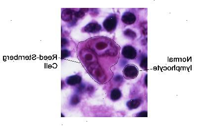 Reed-Sternberg celler. Reed Sternberg-celler er store, unormale lymfocytter som kan inneholde mer enn én kjerne. Disse celler er funnet i Hodgkin lymfom.