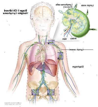 Stage II barndommen Hodgkin lymfom; tegningen viser kreft i lymfeknute grupper over og under mellomgulvet. En innfelt viser en lymfeknute med en lymfe fartøy, en arterie og en vene. Lymfom celler inneholdende cancer er vist i lymfeknute.