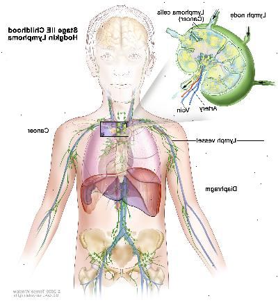 Stage IIE barndommen Hodgkin lymfom; tegningen viser kreft i en lymfeknute gruppe ovenfor mellomgulvet og i venstre lunge. En innfelt viser en lymfeknute med en lymfe fartøy, en arterie og en vene. Lymfom celler inneholdende cancer er vist i lymfeknute.