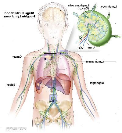 Stage III barndommen Hodgkin lymfom. Kreft er funnet i en eller flere lymfeknute grupper over og under membranen (a). I scenen IIIE, er kreft funnet i lymfeknute grupper over og under mellomgulvet og utenfor lymfeknutene i et nærliggende organ eller område (b). I stadium IIIS er kreft i lymfeknutegrupper over og under membranen (a), og i milten (c). I trinn IIIS pluss E, er kreft i lymfeknutegrupper over og under mellomgulvet, utenfor lymfeknutene i et nærliggende organ eller område (b), og i milten (c).