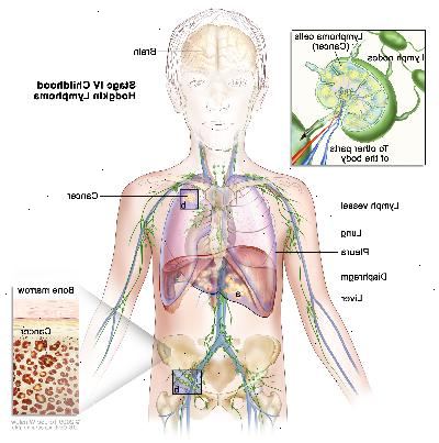 Stadium IV barndommen Hodgkins lymfom; tegningen viser kreft i leveren, venstre lunge, og i en lymfeknute-gruppen under mellomgulvet. Hjernen og pleura er også vist. En innfelt viser kreft sprer seg gjennom lymfeknuter og lymfeårer til andre deler av kroppen. Lymfom celler som inneholder kreft er vist inne i en lymfeknute. En annen innsatt viser kreftceller i benmargen.