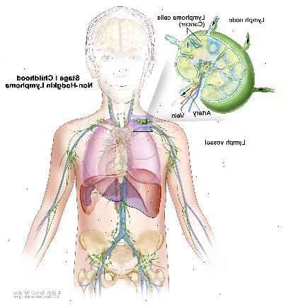 Stadium I barndommen non-Hodgkin lymfom; tegningen viser kreft i en gruppe av lymfeknuter. En innfelt viser en lymfeknute med en lymfe fartøy, en arterie og en vene. Lymfom celler inneholdende cancer er vist i lymfeknute.