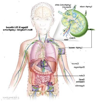 Stage II barndom non-Hodgkin lymfom; tegningen viser kreft i lymfeknute grupper over og under mellomgulvet, i leveren, og i vedlegget. Tykktarmen og tynntarmen blir også vist. En innfelt viser en lymfeknute med en lymfe fartøy, en arterie og en vene. Lymfom celler inneholdende cancer er vist i lymfeknute.