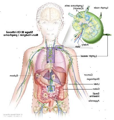 Stage III barndom non-Hodgkin lymfom; tegningen viser kreft i lymfeknute grupper over og under mellomgulvet, i brystet, og hele magen i leveren, milten, tynntarmen, og vedlegg. Tykktarmen er også vist. En innfelt viser en lymfeknute med en lymfe fartøy, en arterie og en vene. Lymfom celler inneholdende cancer er vist i lymfeknute.