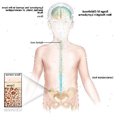 Stadium IV barndommen non-Hodgkin lymfom; tegningen viser hjerne, ryggmarg, og cerebrospinal væske i og rundt i hjernen og ryggmargen. En innfelte viser kreft i benmargen.