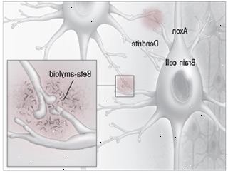 Beta-amyloid plakk