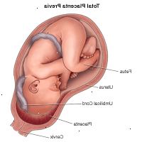 Illustrasjon som viser total placenta previa