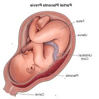 Illustrasjon som viser delvis placenta previa