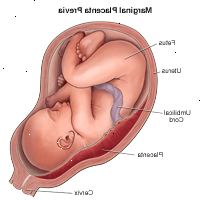 Illustrasjon av marginal placenta previa