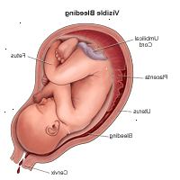 Illustrasjon som viser synlige blødninger under graviditet