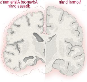 Brain endringer i Alzheimers sykdom