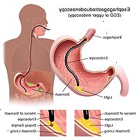 Illustrasjon av en esophagogastroduodenoscopy prosedyre