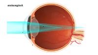 Illustrasjon som viser astigmatisme