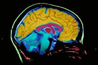 Et bilde av en MR hjernen scan film