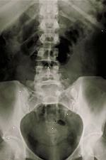 Bilde av en lumbal x-ray