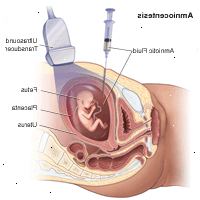 Illustrasjon som viser en fostervannsprøve