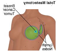 Illustrasjon av en total mastektomi