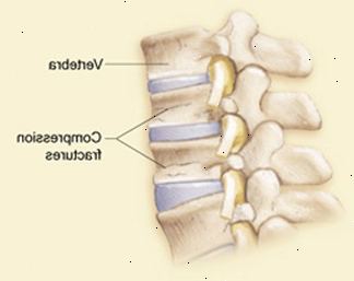 Sidevisning av ryggvirvler og disker som viser komprimering frakturer i ryggvirvler.