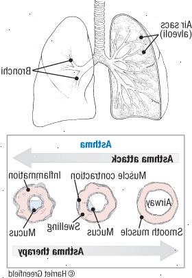 Astma: en reversibel sykdom
