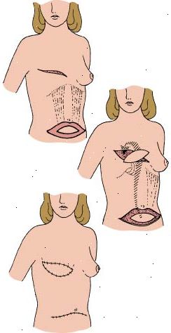 Tram klaff prosedyre som viser hvordan magevevet blir brukt til å rekonstruere fjernet bryst