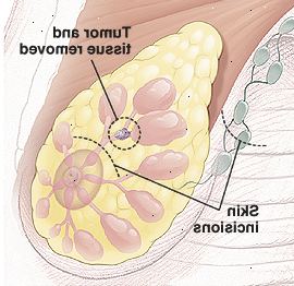 Bryst anatomi med sirkel rundt tumor i kanal som viser vev som skal fjernes. Det er stiplede linjer over brystvorten og i armhulen for å vise små buede snittet nettsteder.