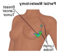 Illustrasjon av en delvis mastektomi